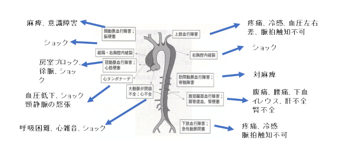 大動脈解離発症時の症状