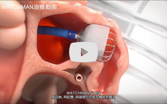 watchman治療動画(外部サイト,別ウィンドウで開く)