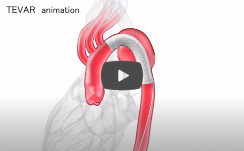 TEVAR動画リンク(外部サイト,別ウィンドウで開く)